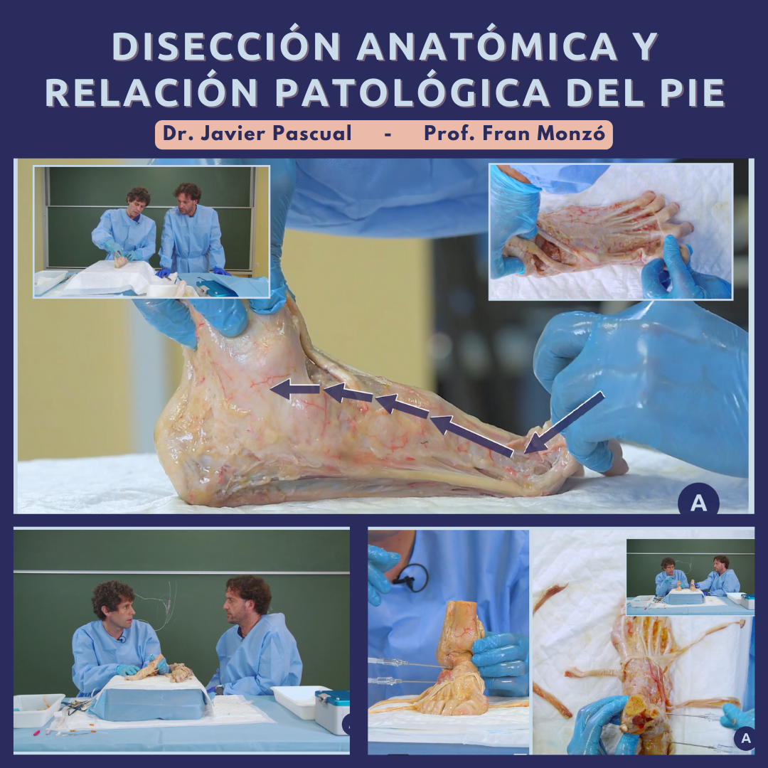 DISECCIÓN ANATÓMICA Y RELACIÓN PATOLÓGICA DEL PIE (1080 × 1080 px)