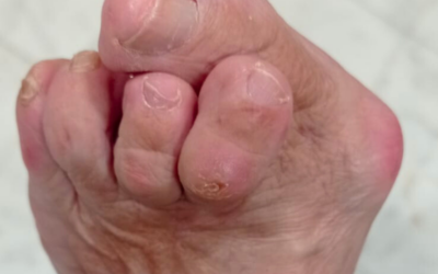 Cómo prevenir los juanetes