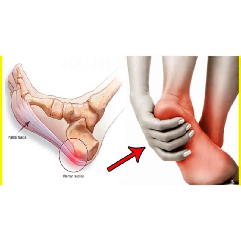 FASCITIS PLANTAR, CUANDO TODO FALLA