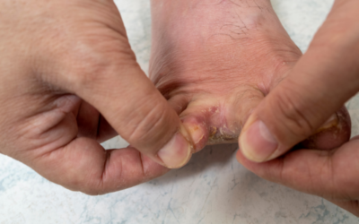 ¿Tienes pie de atleta?