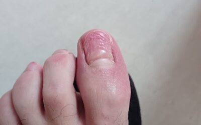 Retroniquia, cuando las uñas se curvan