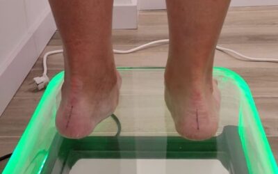 Claves para identificar el Pie Valgo