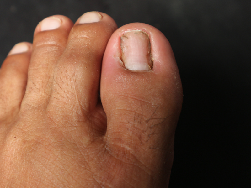 Patologías frecuentes del pie en deportistas