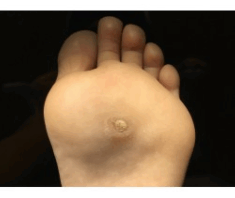 INFECCIÓN POR VPH EN EL PIE – CÓRDOBA