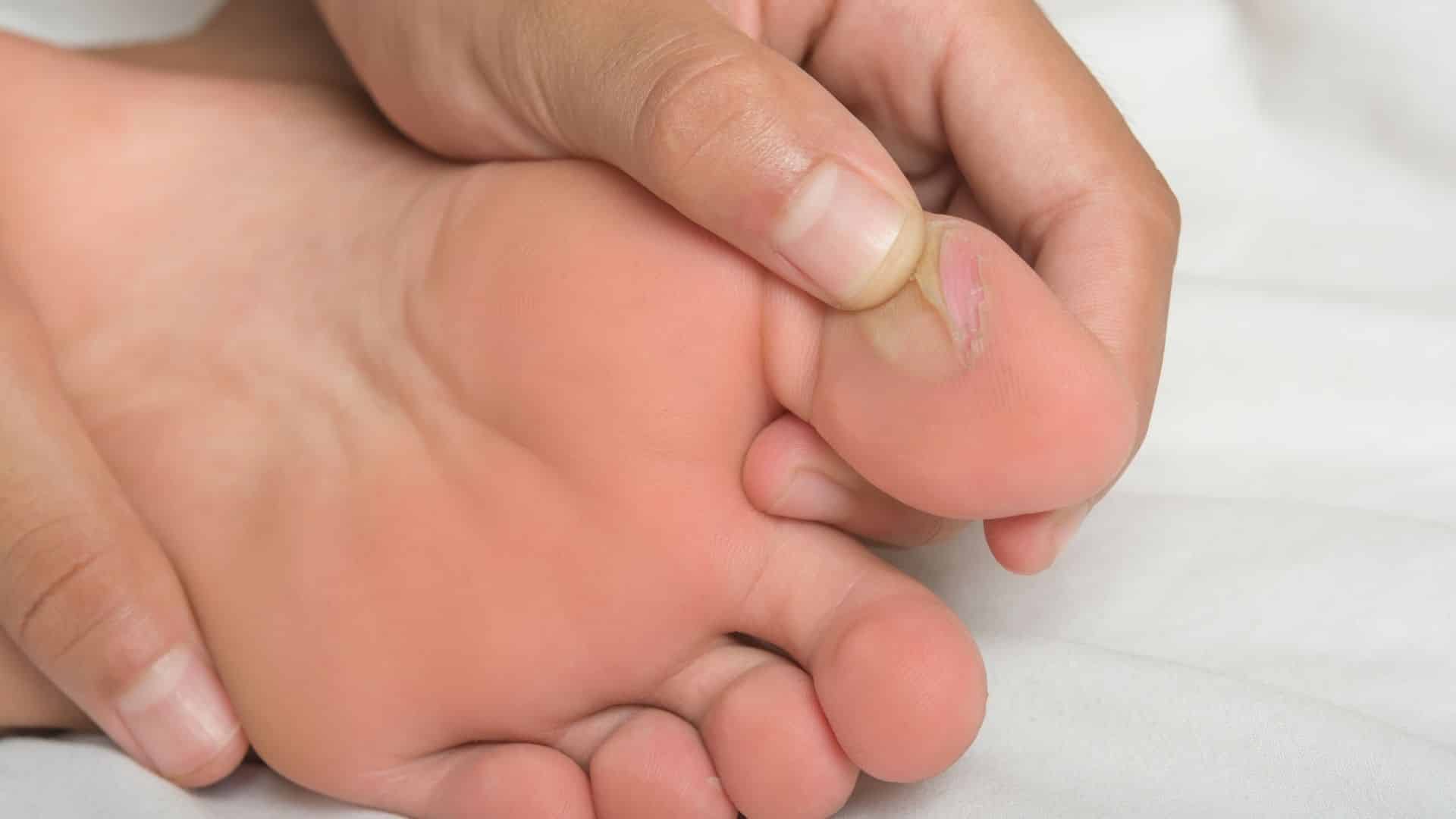 Cómo prevenir ampollas durante las rutas de senderismo en verano