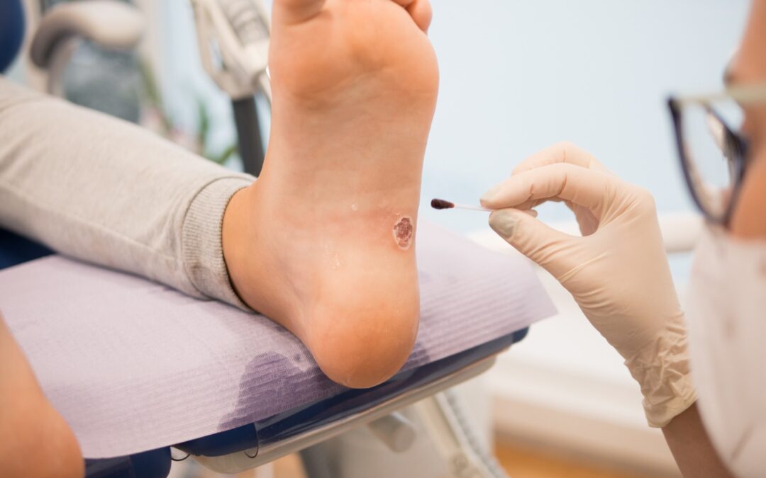 Verrugas plantares en verano: cómo prevenir el contagio y actuar a tiempo