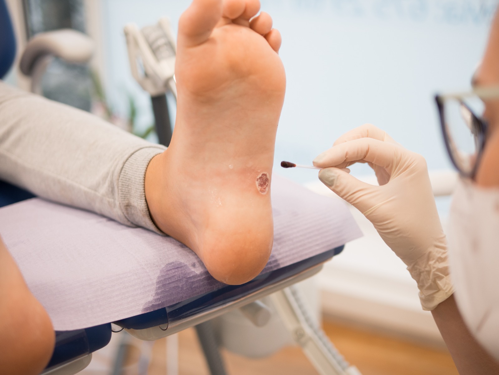 Verrugas plantares en verano: cómo prevenir el contagio y actuar a tiempo