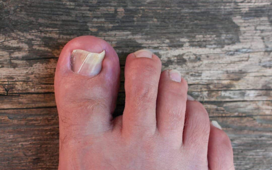Cambios en las uñas: qué tener en cuenta antes de tratarlas